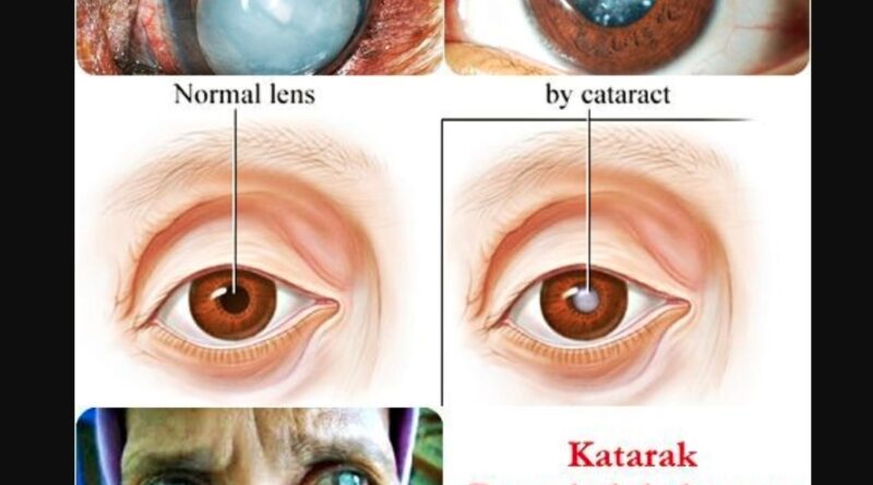 Mata Katarak
