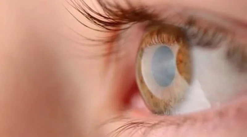 Hal Hal Yang Boleh Dilakukan Setelah LASIK mata